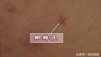 皮肤上长了很多小红点,像小红痣,不痛不痒的是