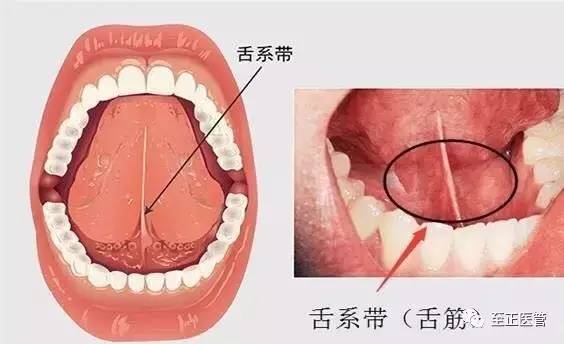 怎么判断宝宝舌系带短不短,该不该剪?麻麻们可不要轻举妄动