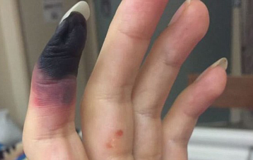 女子感染细菌性咽喉疼被截手指脚趾