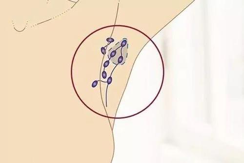 腋窝下有肉疙瘩有点疼,是淋巴癌吗?