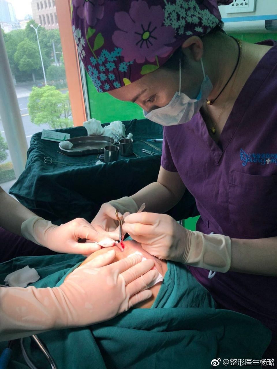 做完激光近视眼手术可以割双眼皮吗?