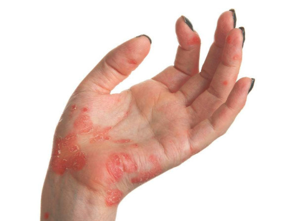 手部真菌性皮炎能否彻底治愈,生活中的最佳护