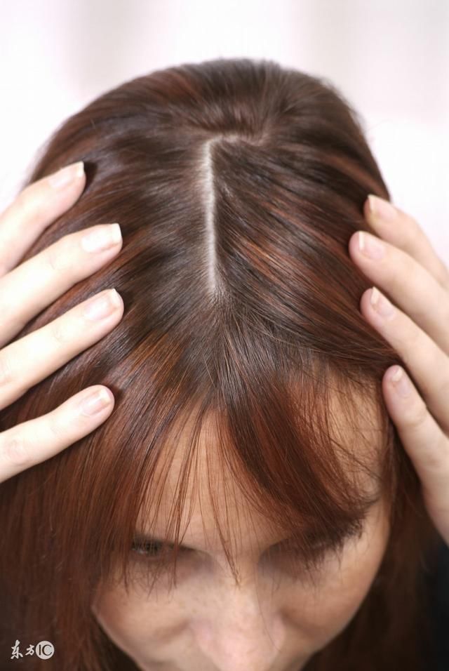 头皮毛囊炎的症状特征