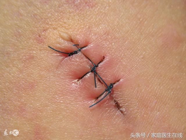 生产时,自然撕裂与侧切有什么不同?妇科医生站出来为大家说真话