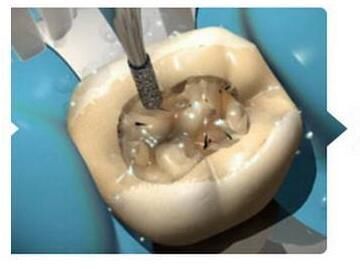 治疗孩子烂牙太凶的根管治疗是咋做的呢?