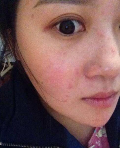 鼻子挤出的小颗粒太多,是螨虫的排泄物凝固,怎