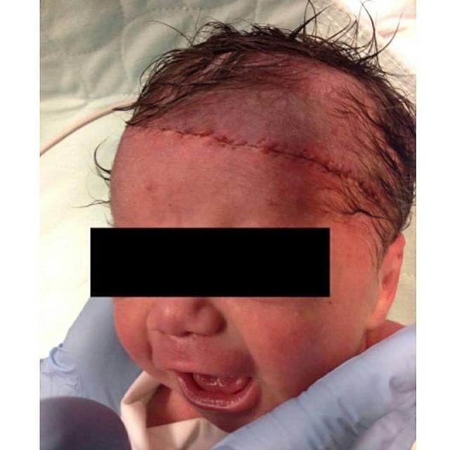 触目惊心!宝宝头皮被切裂17公分,网:妈妈心情难想像