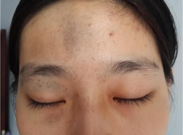 身上有胎记代表什么?这些地方决定你的命运(上