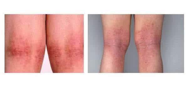 一个简易土方,去湿排毒,2周让湿疹不在,用一个