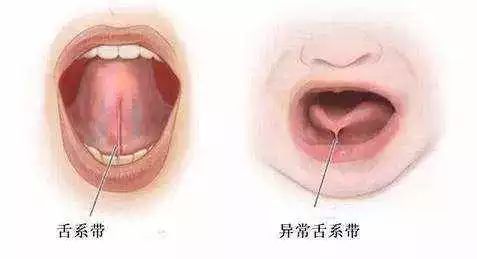 宝宝舌系带过短,剪还是不剪?做手术的最佳年龄