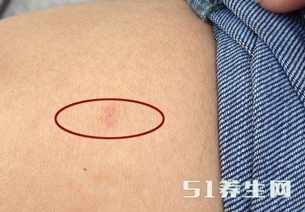 艾滋病刚开始的这些潜在征兆,很多人都不在意