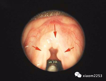 宫颈癌疫苗多少钱一针,二价疫苗和九价疫苗区