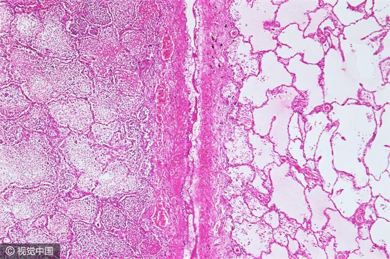 少了一个肾还能活多久?正确答案很可怕-北京时间