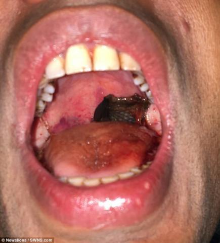 乐极生悲!男子徒手捉鱼 不料活鱼窜入口中卡喉 乐极生悲!男子徒手捉鱼 不料活鱼窜入口中卡喉