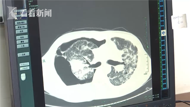 30岁小伙没力气上二楼?一查他的肺竟然千疮百孔