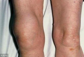 生姜配酒,半月板损伤,膝盖疼缓解了,赶快去用!万人验证