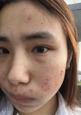 脸上长痘痘怎么办?白酒不仅能喝,还是可以祛痘