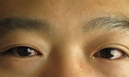 眼屎是什么东西?为何一段时间会感觉很多,那些人需注意