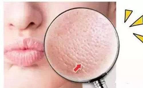 鼻头毛孔粗大,挤出小米粒越多,暗示螨虫越多,记