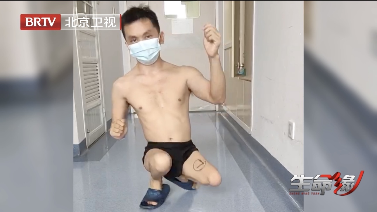 被“打断”腿2次，男子像鸭子一样“蹲行”34年