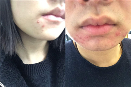 【图】嘴角起痘痘什么原因 这些身体亮起的小