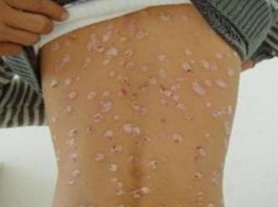 皮肤癣怎么弄才好得快,看完后秒懂