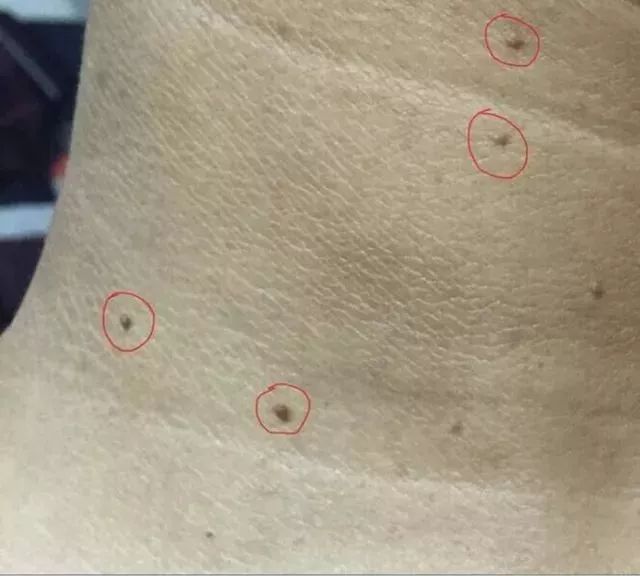 如果眼周,脖子,腋下等地方有长小肉粒,请一定要