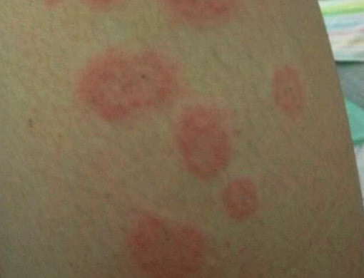 有铜钱癣怎么治疗,3个小方法彻底告别铜钱癣