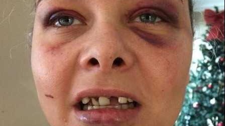 英女子换脸书头像遭男友踹飞三颗牙 一颗嵌入鼻腔 英女子换脸书头像遭男友踹飞三颗牙 一颗嵌入鼻腔