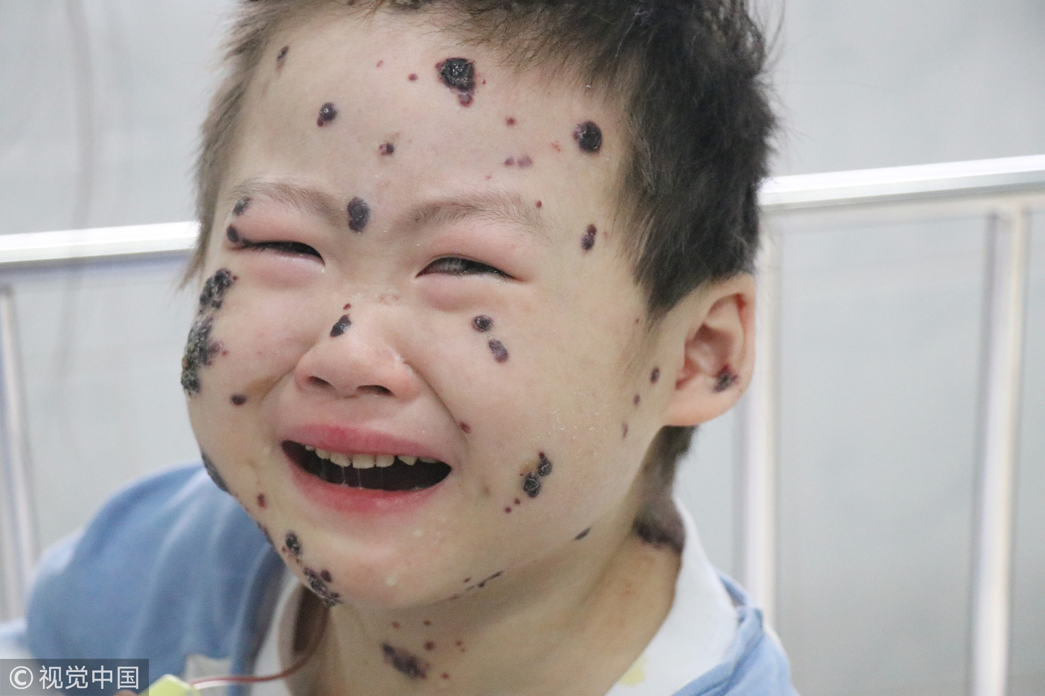 7岁娃浑身长"豹纹" 单亲妈妈携子全国求医