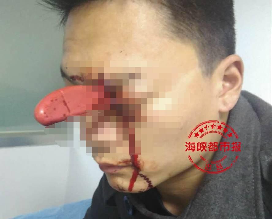 男子头插水果刀 淡定排队就诊 男子头插水果刀 淡定排队就诊