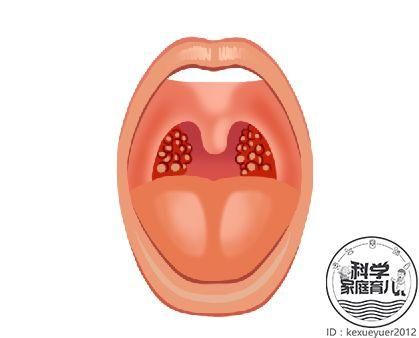 宝宝反复高热、发炎、咽痛,一年≥7次,可能要