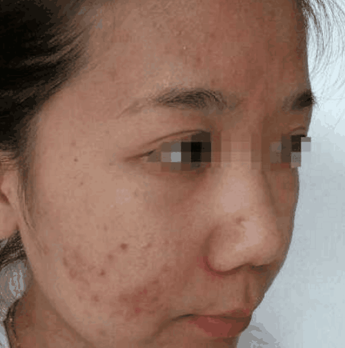 女子面部溃烂, 医生取出个东西后女子瞬间脸红