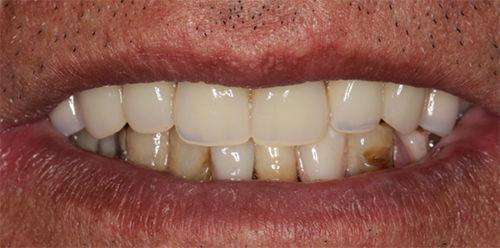 种植牙和真牙有哪些相似之处呢?