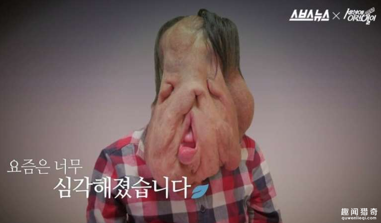 女子因病而五官融化 让人不忍直视