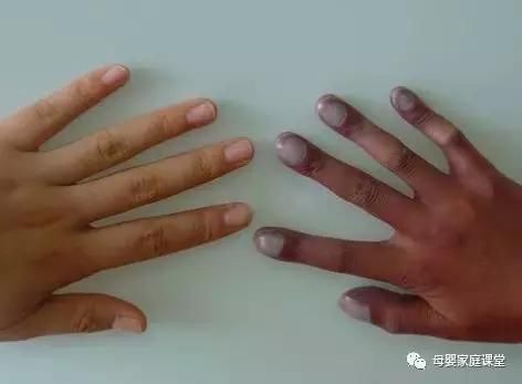 紫绀与先心病:宝宝口唇发紫,才是先心病的征兆