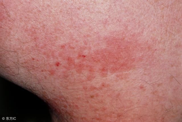 抗癌神药易瑞沙的副作用有哪些?又该如何治疗