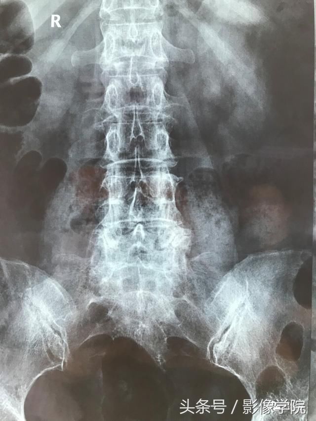 医患通用:如何翻拍X线片,CT片子的网络求医、