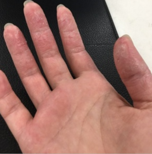 真菌感染的手癣怎么治疗?饮食作息是要有规律