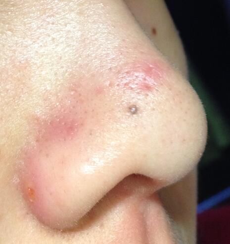 鼻头上的小米粒越多,说明螨虫越多,3方法去螨