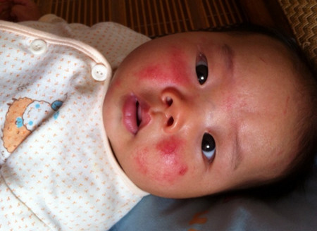 崔玉涛谈湿疹、痱子、坠床、喂奶、疫苗等问题