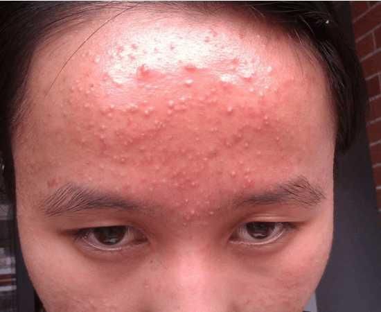 梅梅护肤老师: 痤疮的形成的原因有哪些, 痤疮患