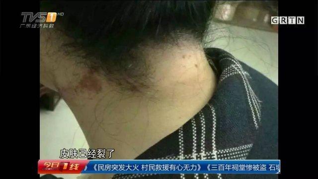 深圳女子街坊烫发直喊痛 竟是药水腐蚀了皮肤