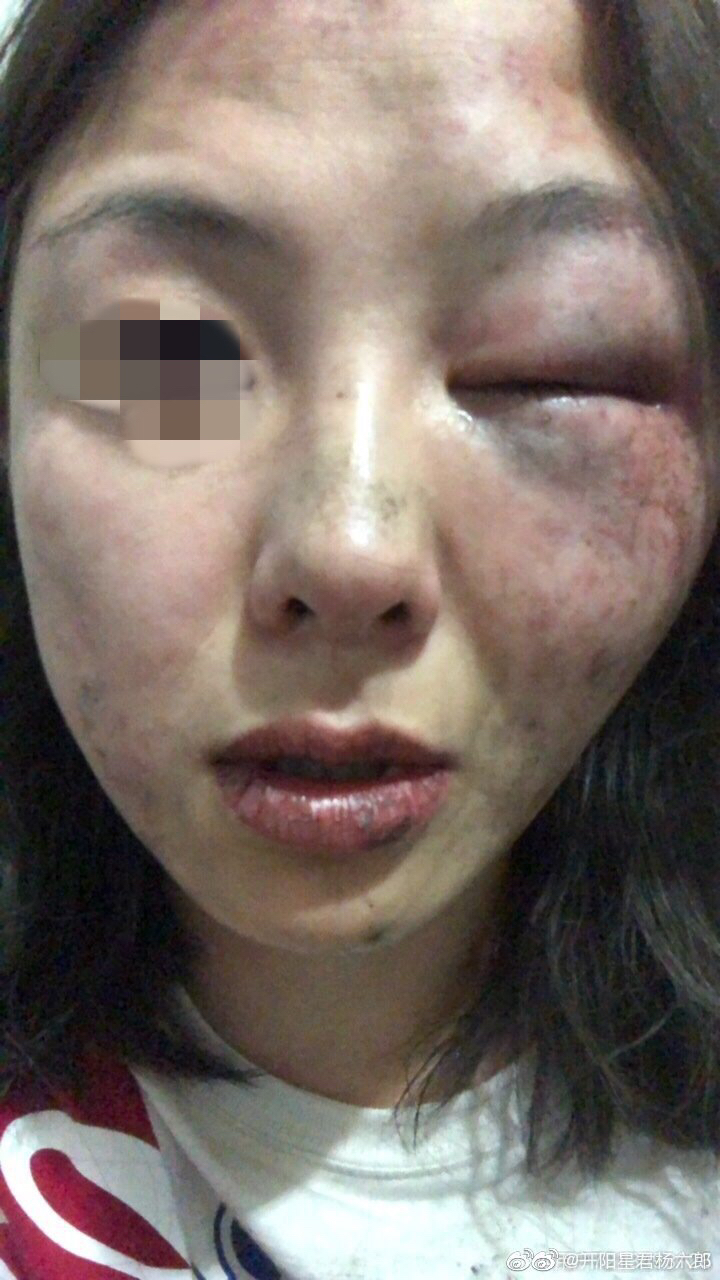 女人鼻青脸肿的图片图片