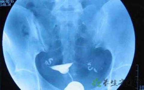 做完造影注意事项