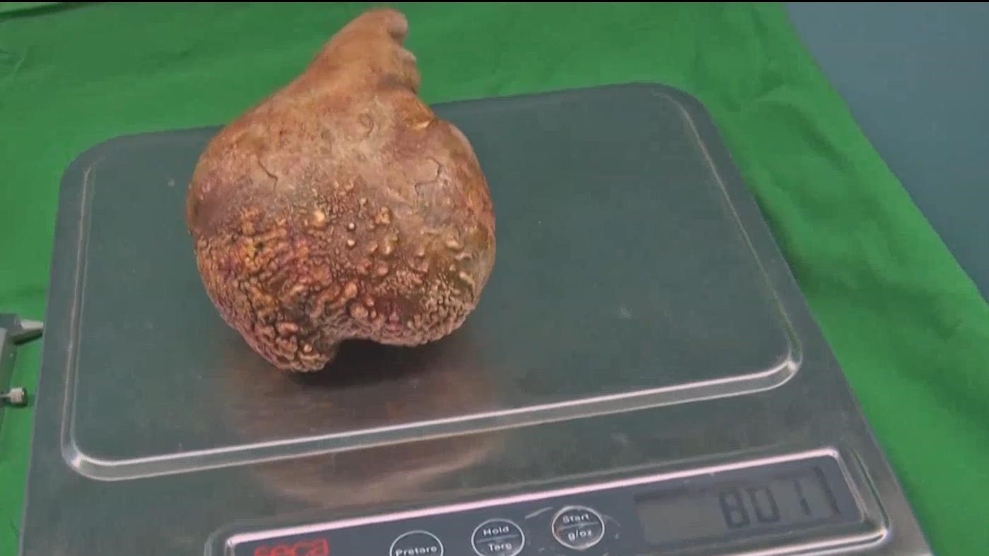 斯里兰卡医院“挖出”世界最大肾结石 斯里兰卡医院“挖出”世界最大肾结石