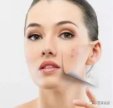 脸上红色痘印发炎怎么办?小豆芽老师教你去除