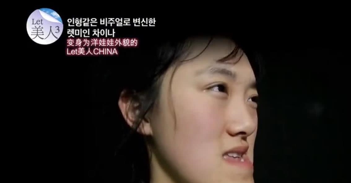 Chinese girl succeeds in Korea plastics, face abou