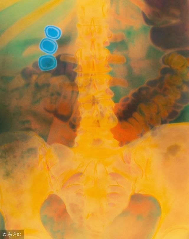 胆结石要切除胆吗?胆结石吃什么排石头