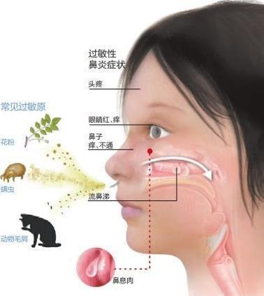 喷嚏不停鼻塞不止,流鼻涕眼睛痒,鼻炎的人要好